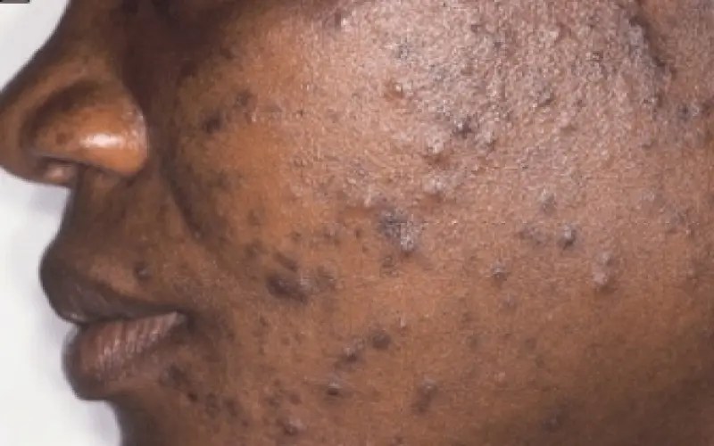 acne scars worse