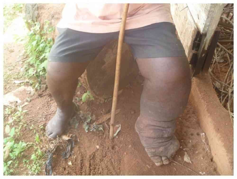 elephantiasis